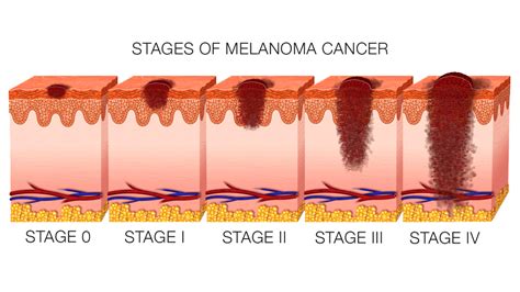 Many people do not learn that they have lung cancer until the disease is in its later stages. Signs and symptoms and photographs of stage 4 melanoma ...