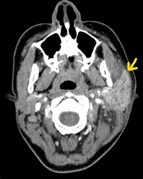 Mumps Presenting With Unilateral Synchronous Parotid And Submandibular
