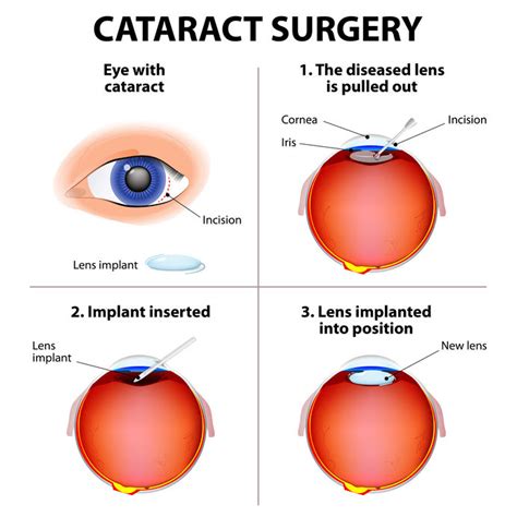 What To Expect After Cataract Surgery Eye Clinic Of Florida