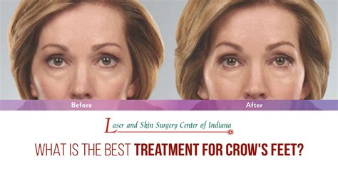 Crows Feet Treatment Options Laser And Skin Surgery Center Of Indiana