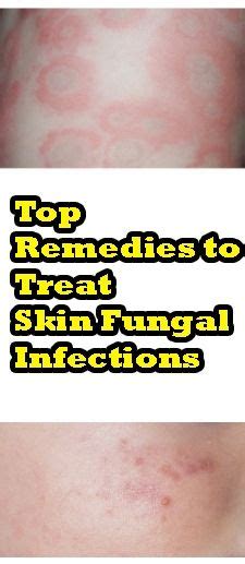 Top Remedies To Treat Skin Fungal Infections With Images Fungal