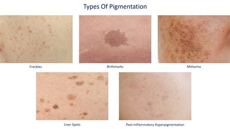 Get Rid Of Hyperpigmentation With Home Remedies Dream Plastic Surgery
