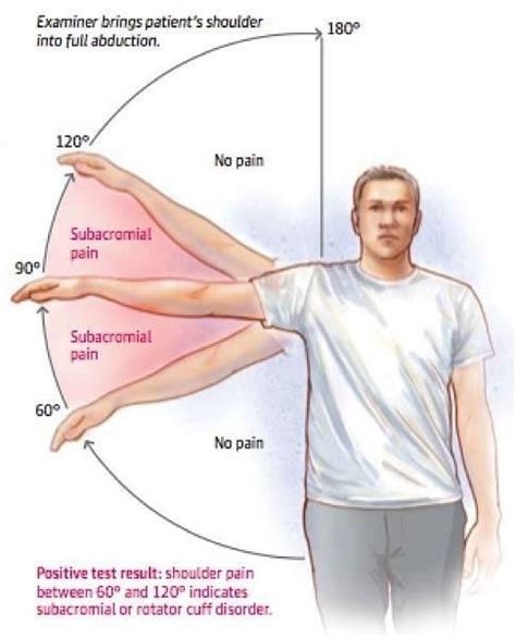 Shoulder Abduction Manual Muscle Test