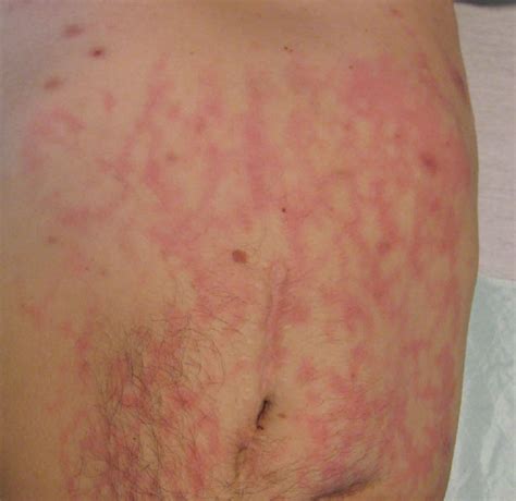 Toasted Skin Syndrome Causes Symptoms Diagnosis Treatment And Prognosis