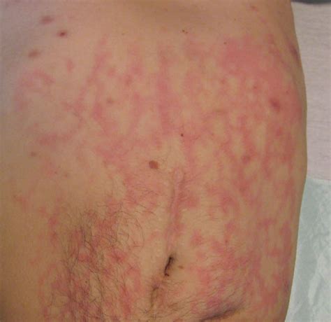 Erythema Ab Igne Causes Symptoms Diagnosis Treatment And Prognosis