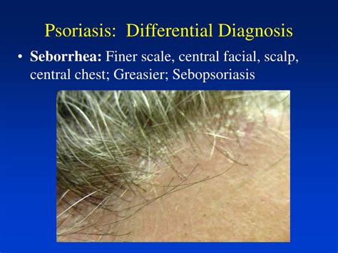 Ppt Overview Of Psoriasis Powerpoint Presentation Free Download Id