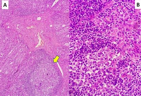 Histologic Sections Of Hashimotos Thyroiditis Showing Exaggerated