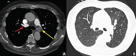 When Does Chest Ct Require Contrast Enhancement