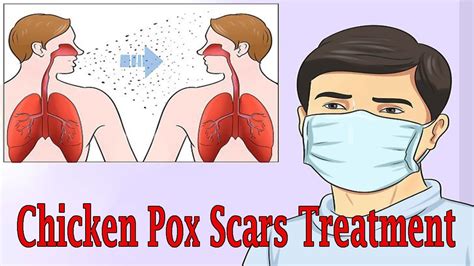 How To Prevent Chicken Pox Scars Using Natural Home Remedies Youtube