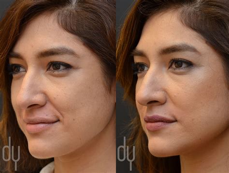 Smile Lines Filler Before And After