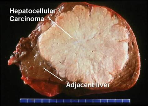 A Hepatocellular Carcinoma Liver Cancer Download Scientific Diagram