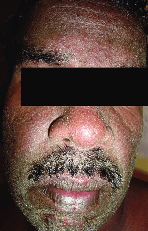 Erythematous Scaly Rash Of Drug Reaction With Eosinophilia And Systemic