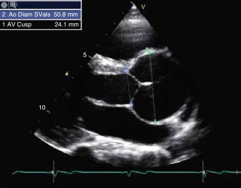 Echocardiographic Long Axis Image Of A Marfan Patient With Aortic Root