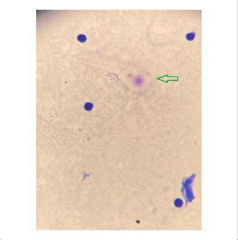 Gram Staining Of The Cerebrospinal Fluid Sample Revealed Budding