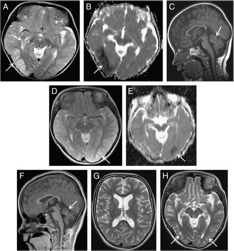 Congenital Ataxia And Hemiplegic Migraine With Cerebral Edema