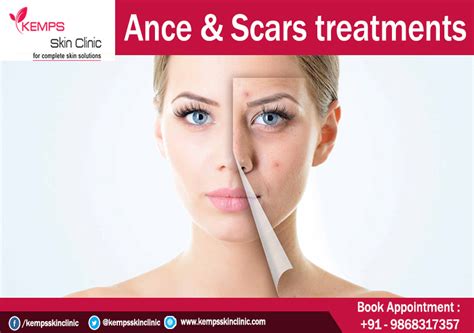 What Is The Best Treatment For Acne Scars On Face Kemps Skin Clinic