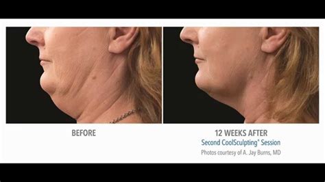Coolmini Coolsculpting Double Chin Fat Reduction Youtube