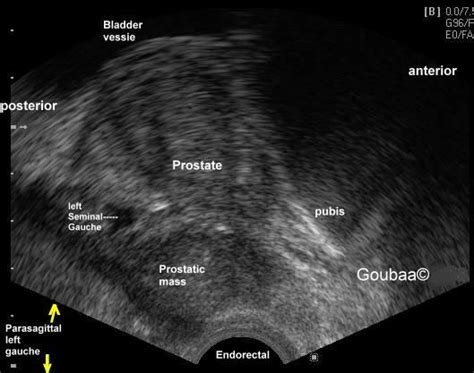 Healthy Prostate Club — What Is A Transrectal Ultrasound Of The Prostate