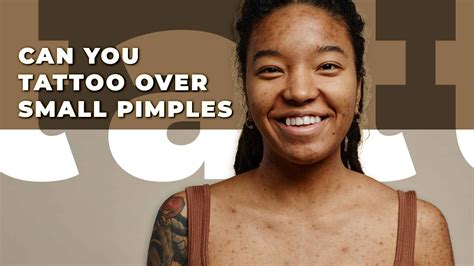 Tattoos And Acne What You Need To Know Before Getting Inked