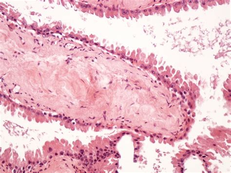 Pathology Outlines Hidrocystoma