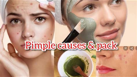Pimple Removal Face Pack😰 Pimple Causes And Face Pack For Pimple Youtube