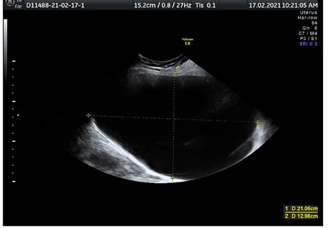Cureus Paracentesis Of An Ovarian Cyst During Second Trimester Pregnancy