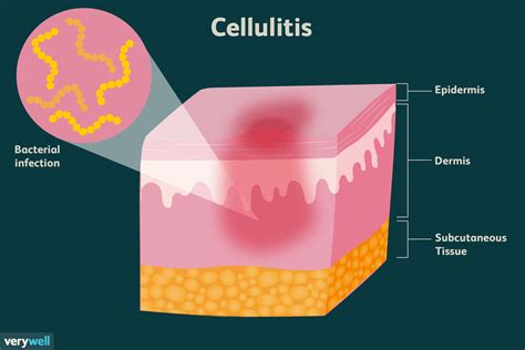 Cellulitis Symptoms Treatment And More