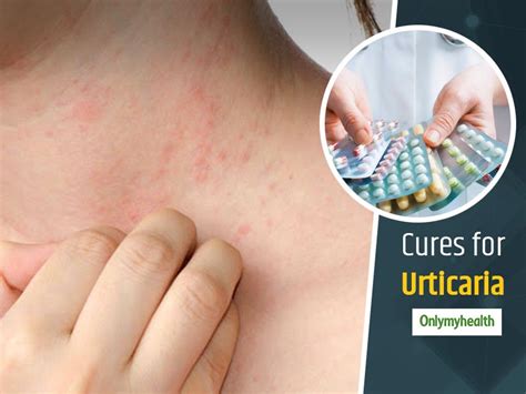 Heres Everything You Need To Know About Urticaria Symptoms Causes And Treatment Onlymyhealth
