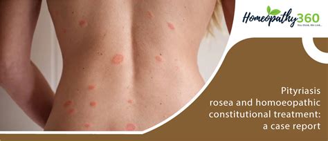 Pityriasis Rosea Rash Symptoms Causes Treatment With Homeopathic The