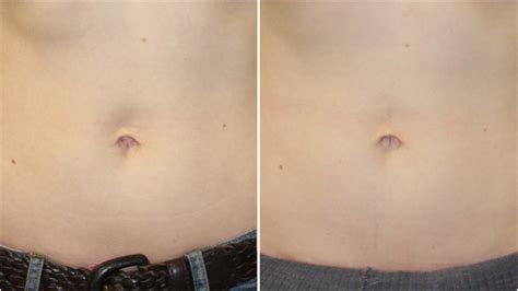 Belly Button Outie After Pregnancy