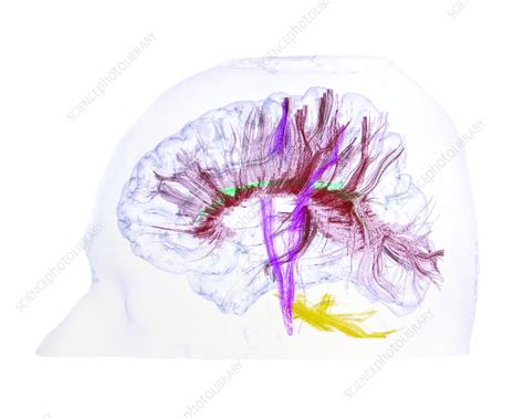 Advanced Mri Brain Scan Stock Image P3320519 Science Photo Library