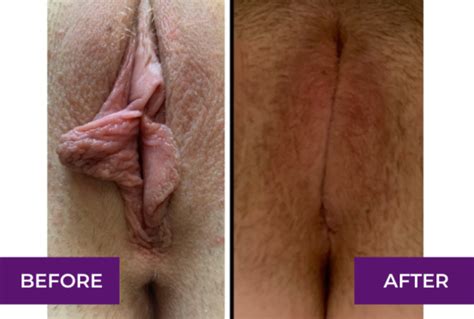 Labiaplasty Before And After In Los Angeles Glendale Dr Michael Tahery