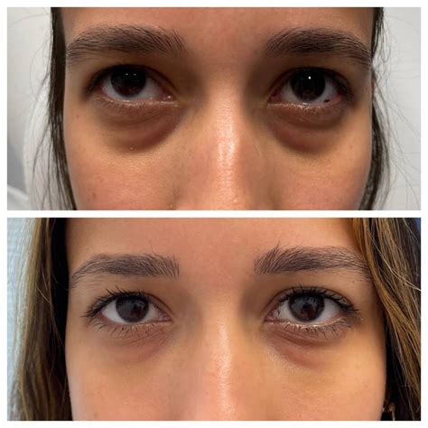 Eyelid Lift Without Surgery And Non Surgical Eyelid Lift Jacksonville