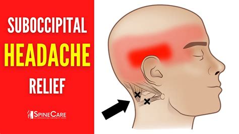 How To Release Tight Suboccipital Muscles Headache Relief In Seconds Youtube