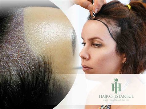 Women And Hair Transplant Myths And Realities Hair Of Istanbul