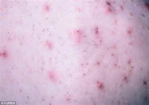 Adult Acne On Rise 200 Due To Stress Poor Diets And Pollution Daily