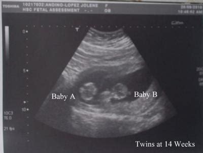 The expected due date (edd) is calculated from the first date of your last. The Twins at 14 Weeks