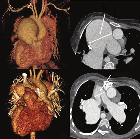 Cardiac Ct With 3d Reconstruction A B Preoperative Image Shows
