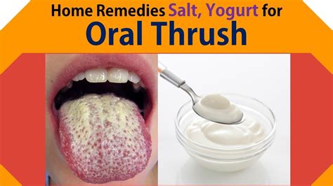 Home Remedies For Thrush Natural Remedy From Your Kitchen Kitchen
