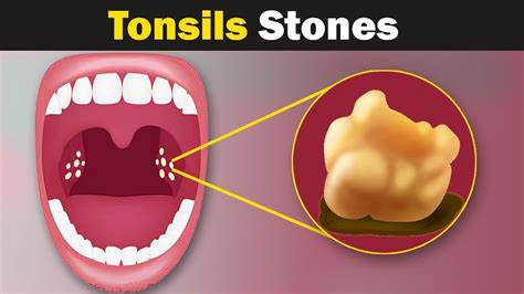 What Are Tonsil Stone Youtube