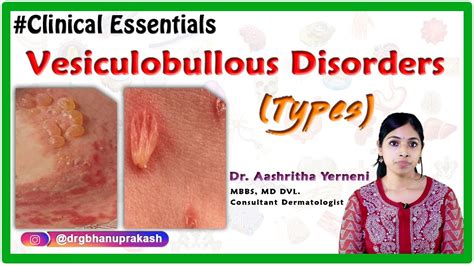 Vesiculobullous Disorders Types Clinical Essentials Draashritha