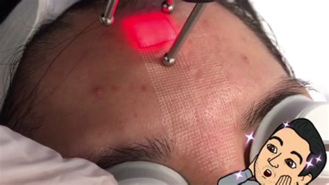 Nano Ray Laser Skin Resurfacing For Clear Poreless Skin