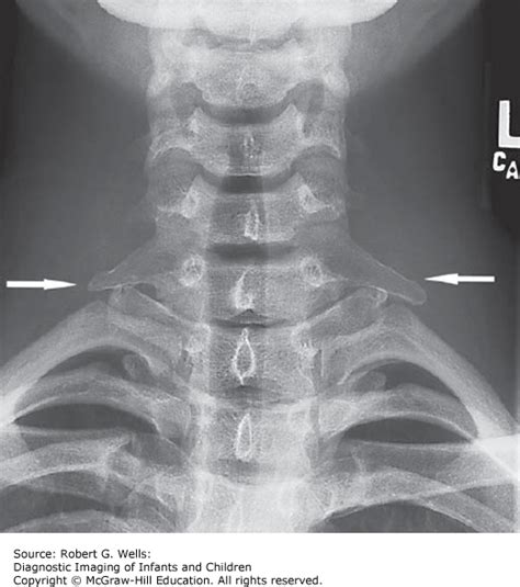 Developmental Abnormalities Of The Spine Obgyn Key
