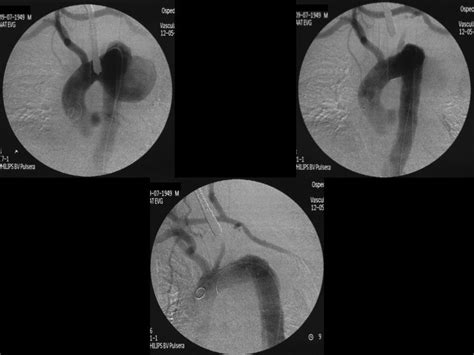 Ruptured Hemiarch And Descending Thoracic Aorta Aneurysm Hybrid