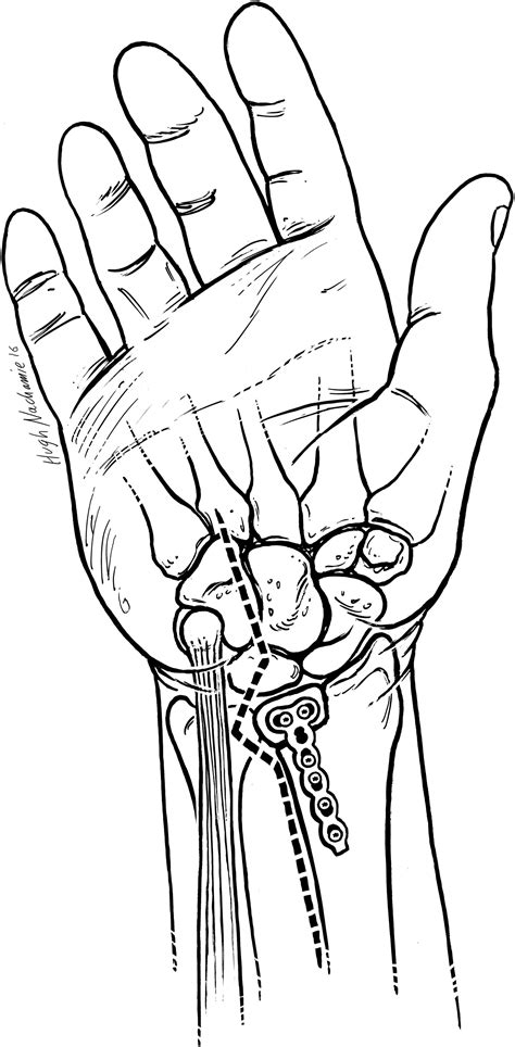 Volar Ulnar Approach For Fixation Of The Volar Lunate Facet Fragment In