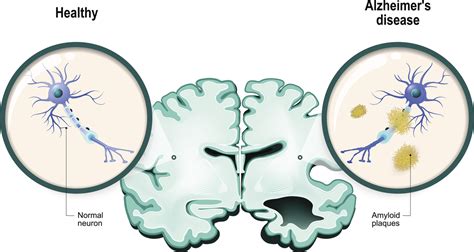 Alzheimers Disease Neurons And Brain M1 Imaging Center