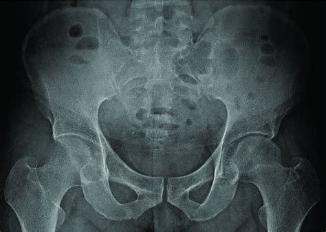 X Rays And Scans Can Fail To Differentiate Hip Pathology From Lumbar