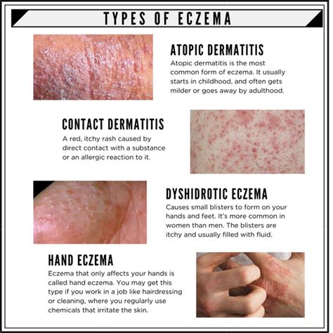 7 Types Of Eczema And Its Symptoms Sevda New
