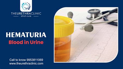 Hematuria Blood In Urine Causes Symptoms And More The Urethra Clinic