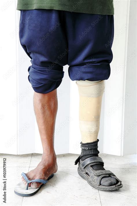 Amputee Wearing A Prosthetic Leg Standing Close Up View Of Their Leg